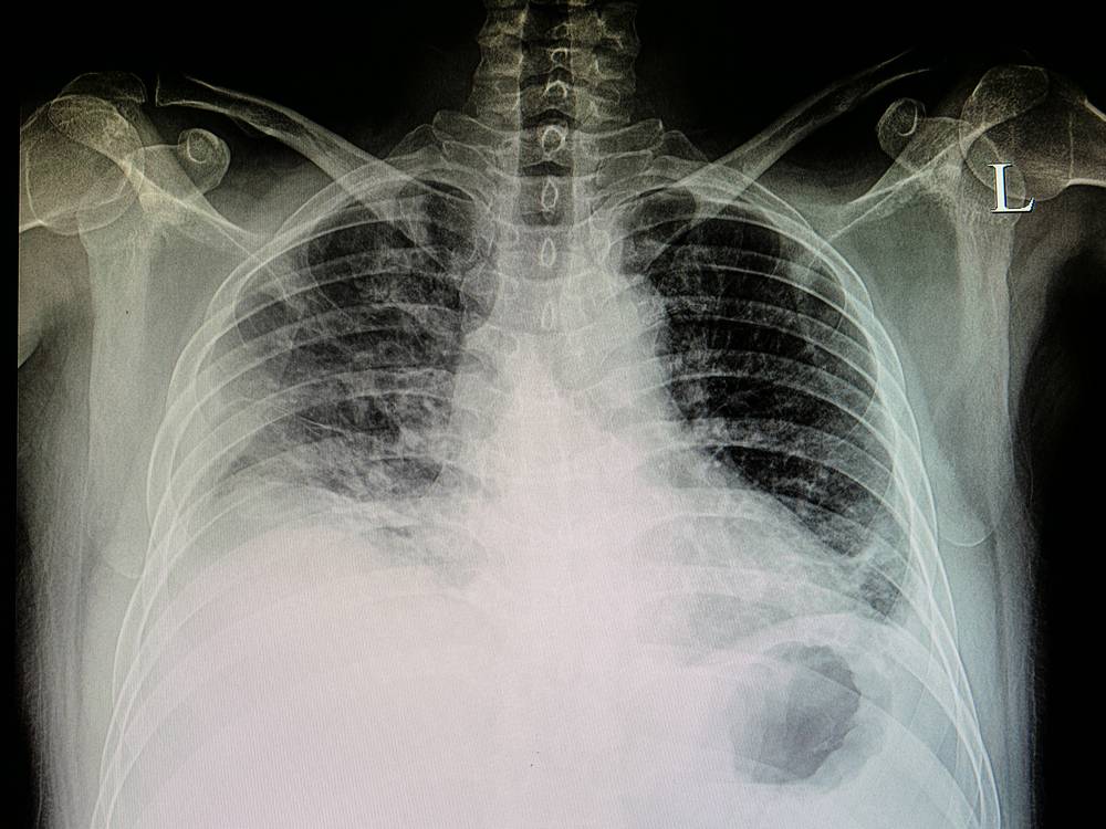 Каким образом делают рентгенографию грудной клетки маленькому ребенку?