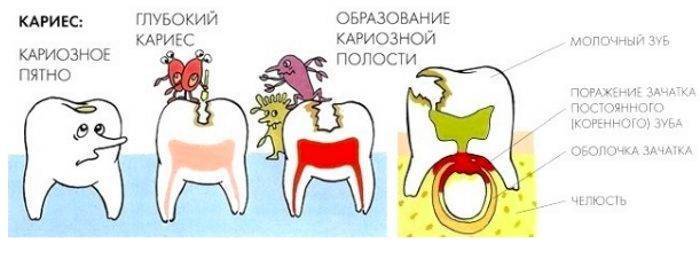 Лечение зубов у детей