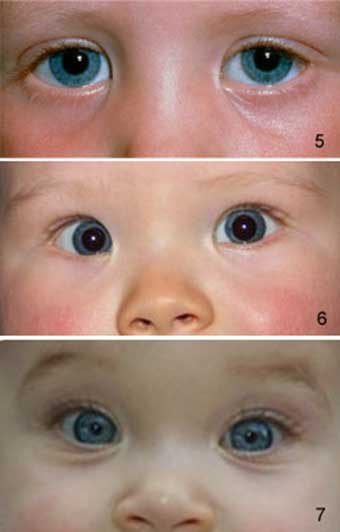 Формирование зрения у новорожденных детей