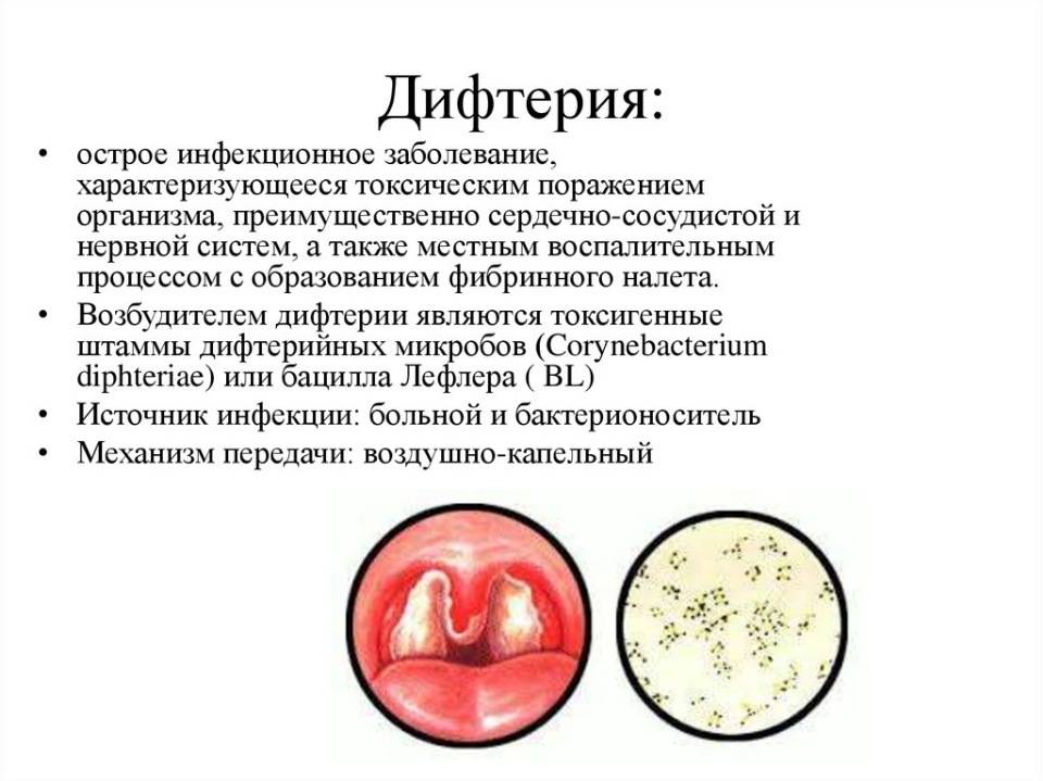Особенности бактериальной ангины: симптомы, причины возникновения, лечение