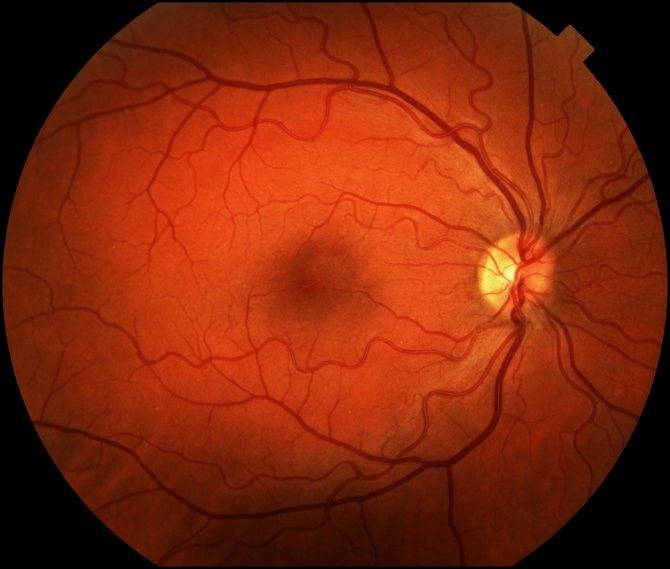 Отслойка сетчатки глаза: операция и лечение лазером при отслоение сетчатки глаза