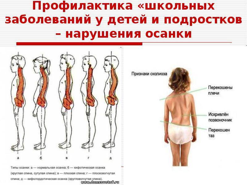Сколиоз 1 и 2 степени. реабилитация, лечение, симптомы, причины, диагностика | центр дикуля