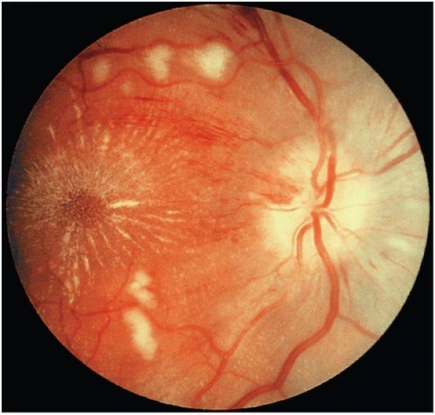 Как проявляется диабетическая ретинопатия